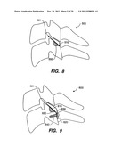 Apparatus for Sizing a Facet Joint diagram and image