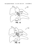 Apparatus for Sizing a Facet Joint diagram and image