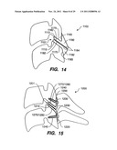 Apparatus for Sizing a Facet Joint diagram and image