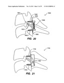 Apparatus for Sizing a Facet Joint diagram and image