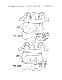 Apparatus for Sizing a Facet Joint diagram and image