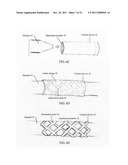 TISSUE FIXATION diagram and image