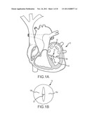 APPARATUS AND METHOD FOR JOINING ADJACENT TISSUE diagram and image