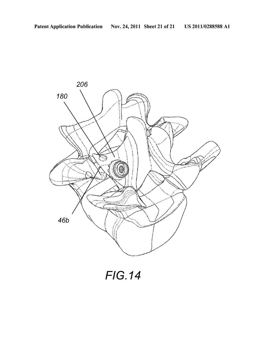 SYSTEM AND METHOD FOR FACET FIXATION AND FUSION - diagram, schematic, and image 22