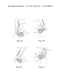 Method and Apparatus for Performing Spinal Fusion Surgery diagram and image