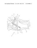 Method and Apparatus for Fixing a Graft in a Bone Tunnel diagram and image