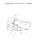 Method and Apparatus for Fixing a Graft in a Bone Tunnel diagram and image