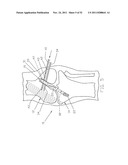 Method and Apparatus for Fixing a Graft in a Bone Tunnel diagram and image