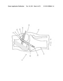 Method and Apparatus for Fixing a Graft in a Bone Tunnel diagram and image