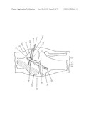 Method and Apparatus for Fixing a Graft in a Bone Tunnel diagram and image