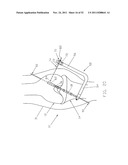 Method and Apparatus for Fixing a Graft in a Bone Tunnel diagram and image