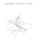 Method and Apparatus for Fixing a Graft in a Bone Tunnel diagram and image