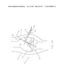 Method and Apparatus for Fixing a Graft in a Bone Tunnel diagram and image