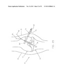 Method and Apparatus for Fixing a Graft in a Bone Tunnel diagram and image