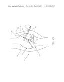 Method and Apparatus for Fixing a Graft in a Bone Tunnel diagram and image