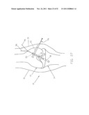 Method and Apparatus for Fixing a Graft in a Bone Tunnel diagram and image