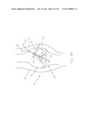 Method and Apparatus for Fixing a Graft in a Bone Tunnel diagram and image