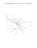 Method and Apparatus for Fixing a Graft in a Bone Tunnel diagram and image