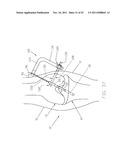 Method and Apparatus for Fixing a Graft in a Bone Tunnel diagram and image