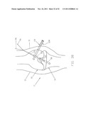 Method and Apparatus for Fixing a Graft in a Bone Tunnel diagram and image