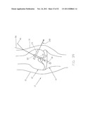 Method and Apparatus for Fixing a Graft in a Bone Tunnel diagram and image