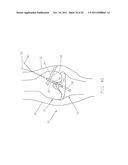 Method and Apparatus for Fixing a Graft in a Bone Tunnel diagram and image