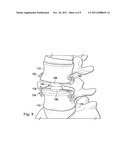 INTERVERTEBRAL PROSTHETIC SYSTEMS, DEVICES, AND ASSOCIATED METHODS diagram and image