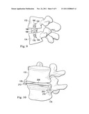 INTERVERTEBRAL PROSTHETIC SYSTEMS, DEVICES, AND ASSOCIATED METHODS diagram and image