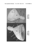 ILIAC CANAL PROSTHESIS diagram and image