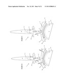 ILIAC CANAL PROSTHESIS diagram and image