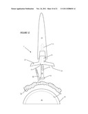 ILIAC CANAL PROSTHESIS diagram and image