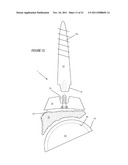 ILIAC CANAL PROSTHESIS diagram and image