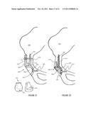 ILIAC CANAL PROSTHESIS diagram and image