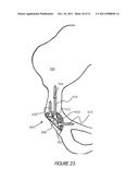 ILIAC CANAL PROSTHESIS diagram and image