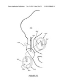 ILIAC CANAL PROSTHESIS diagram and image