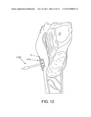 SWALLOW EXPANSION DEVICE diagram and image