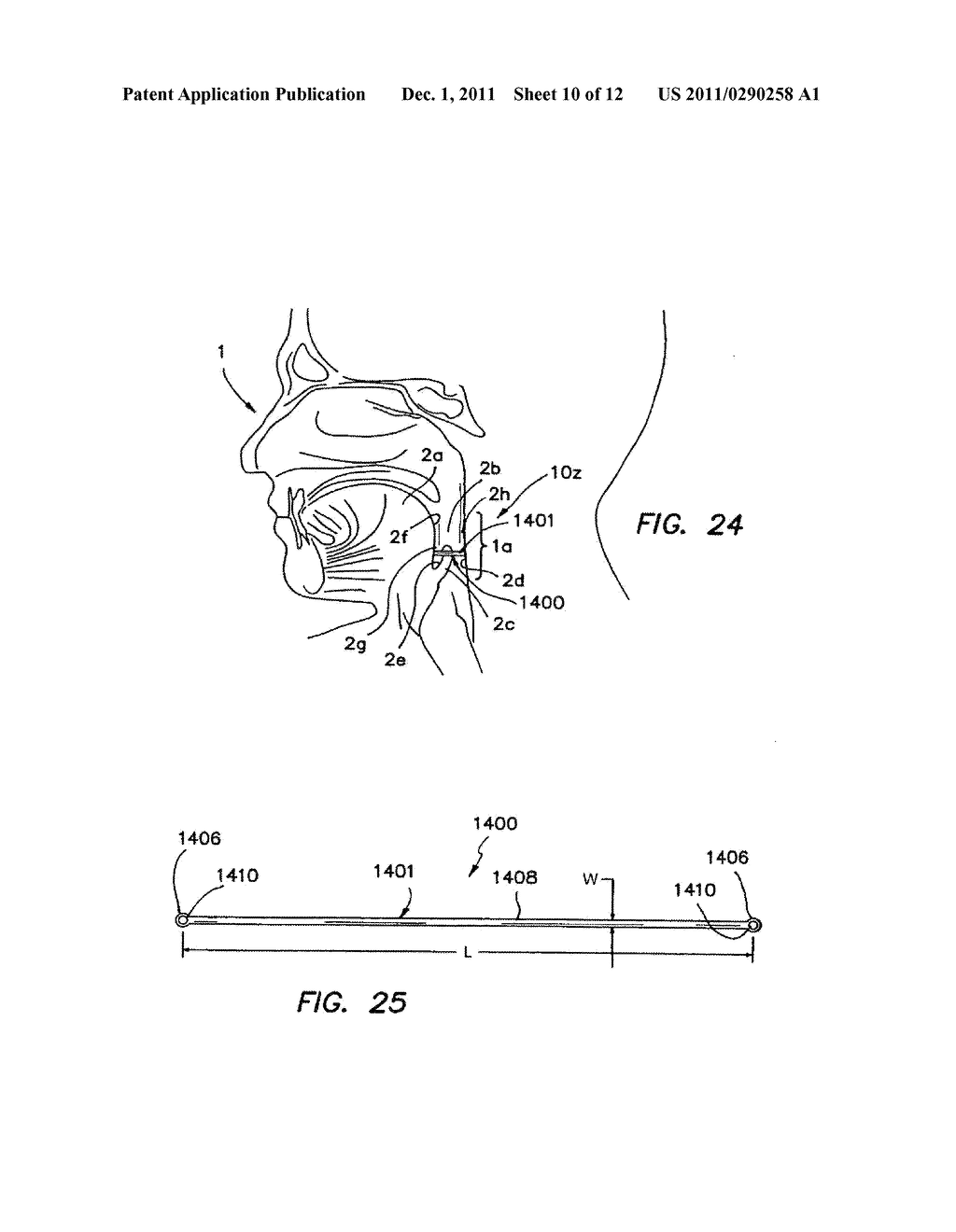 APPARATUS AND METHODS FOR TREATING SLEEP APNEA - diagram, schematic, and image 11