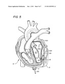 METHOD OF TREATING CORONARY ARTERIES WITH PERIVASCULAR DELIVERY OF     THERAPEUTIC AGENTS diagram and image