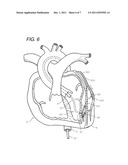 METHOD OF TREATING CORONARY ARTERIES WITH PERIVASCULAR DELIVERY OF     THERAPEUTIC AGENTS diagram and image