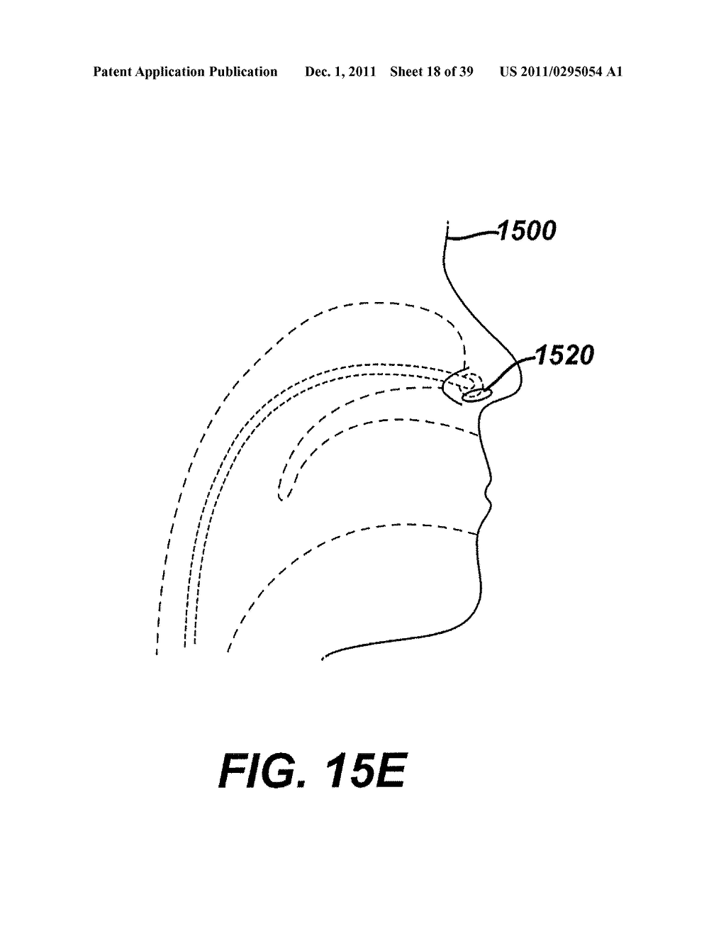 Method of Filling an Intraluminal Reservoir with a Therapeutic Substance - diagram, schematic, and image 19