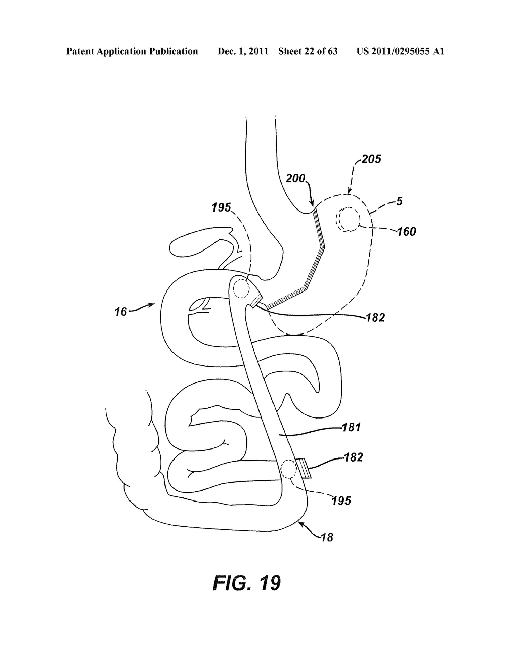 Methods and Devices For The Rerouting Of Chyme To Induct Intestinal Brake - diagram, schematic, and image 23