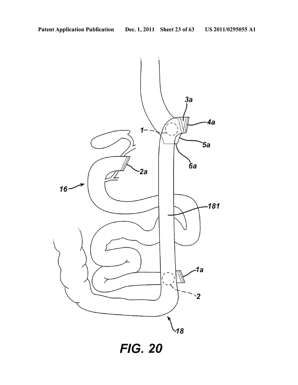 Methods and Devices For The Rerouting Of Chyme To Induct Intestinal Brake - diagram, schematic, and image 24
