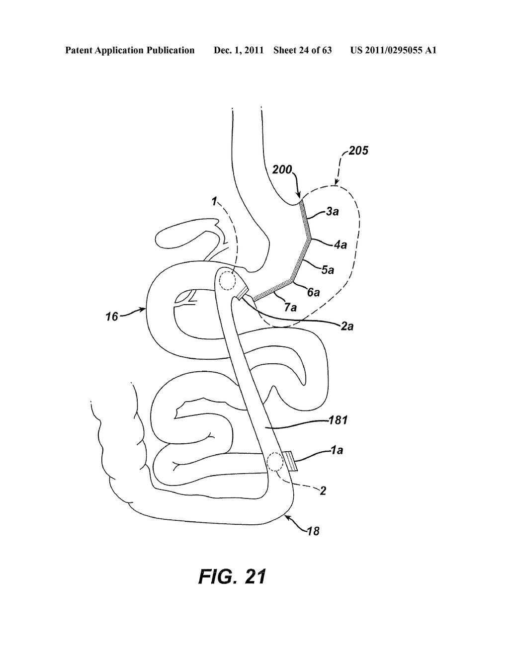 Methods and Devices For The Rerouting Of Chyme To Induct Intestinal Brake - diagram, schematic, and image 25