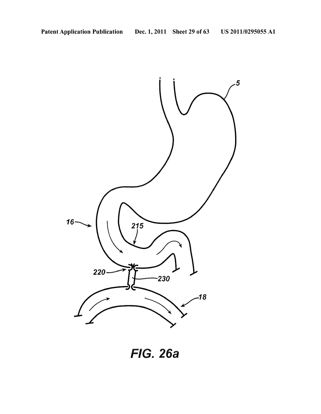 Methods and Devices For The Rerouting Of Chyme To Induct Intestinal Brake - diagram, schematic, and image 30