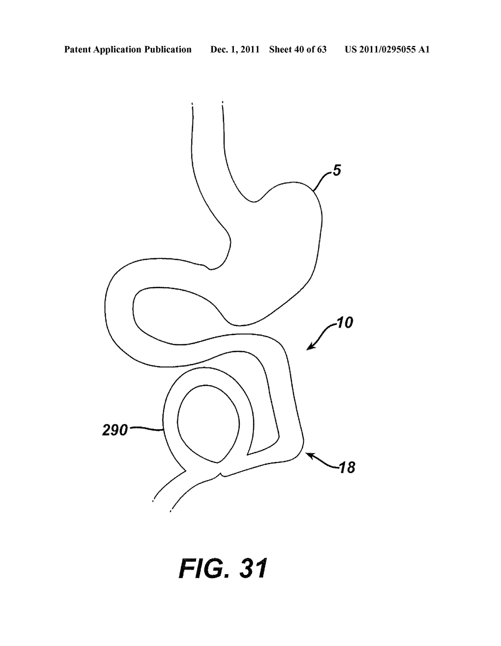 Methods and Devices For The Rerouting Of Chyme To Induct Intestinal Brake - diagram, schematic, and image 41