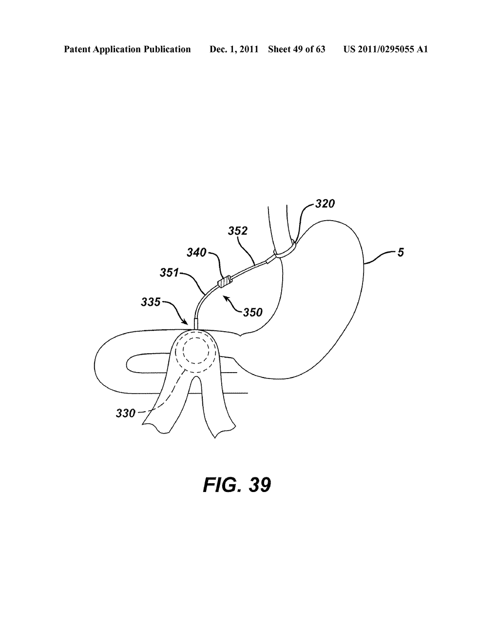 Methods and Devices For The Rerouting Of Chyme To Induct Intestinal Brake - diagram, schematic, and image 50