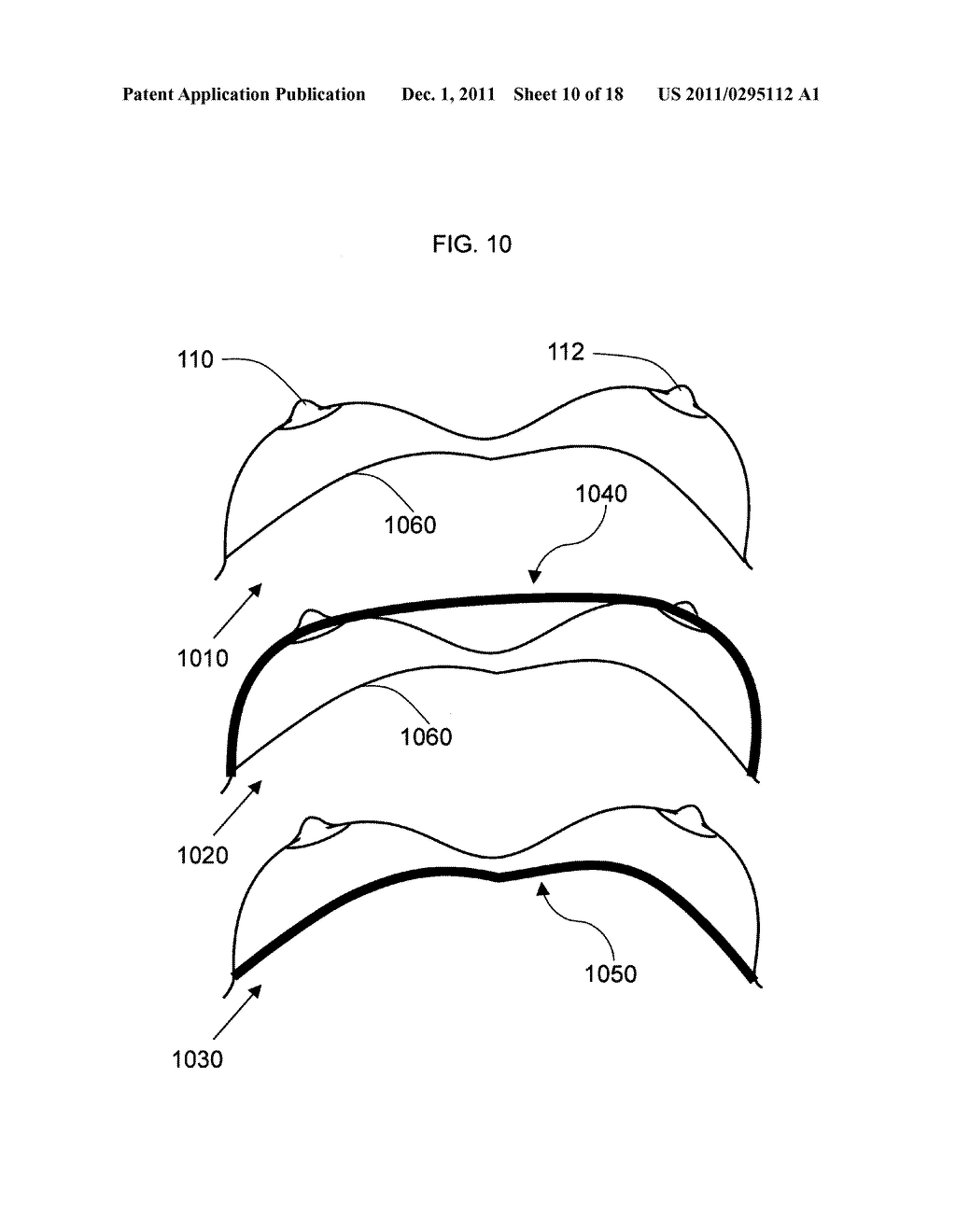 Anatomical recognition and dimensional analysis of breast volume to assist     breast surgery - diagram, schematic, and image 11