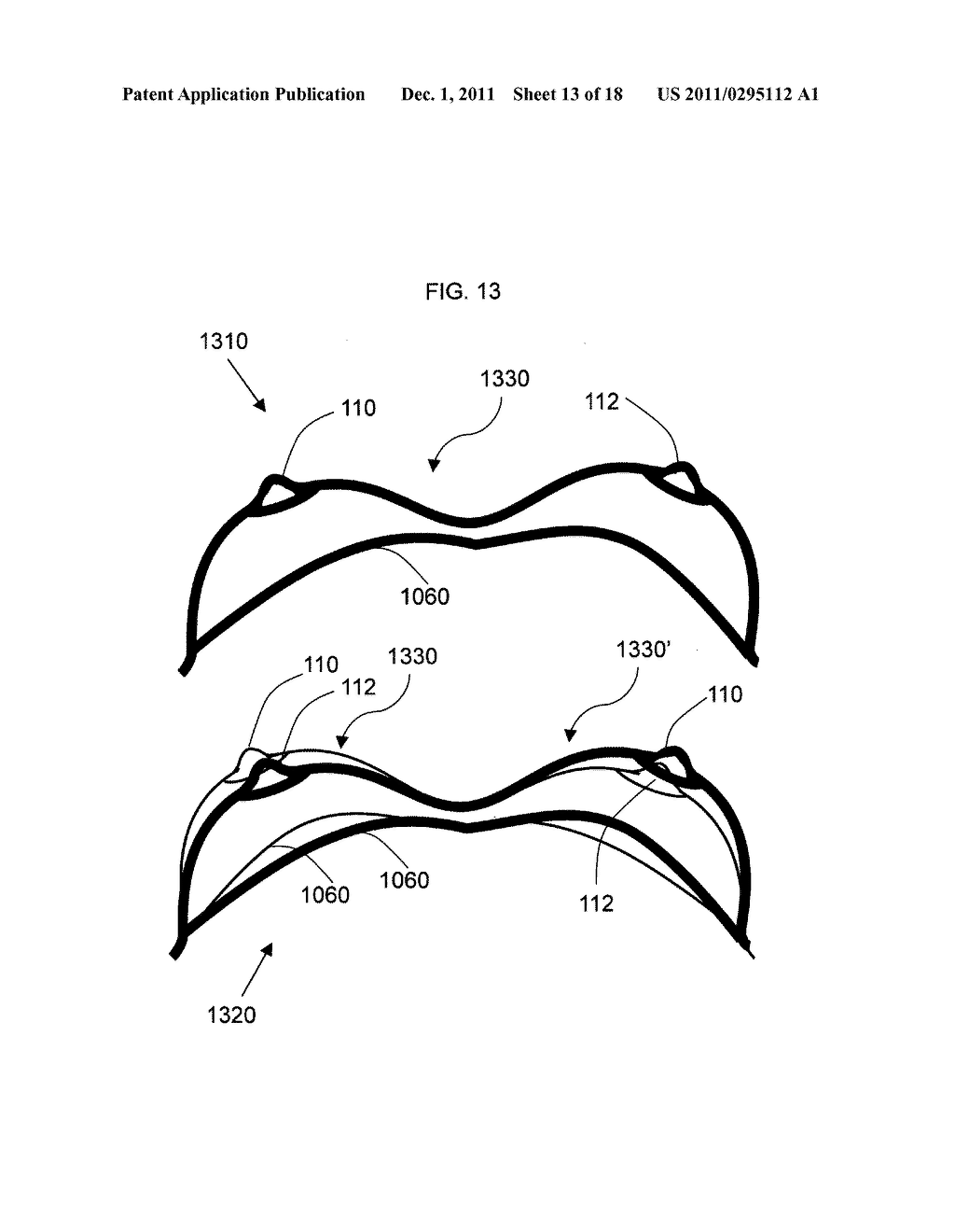 Anatomical recognition and dimensional analysis of breast volume to assist     breast surgery - diagram, schematic, and image 14