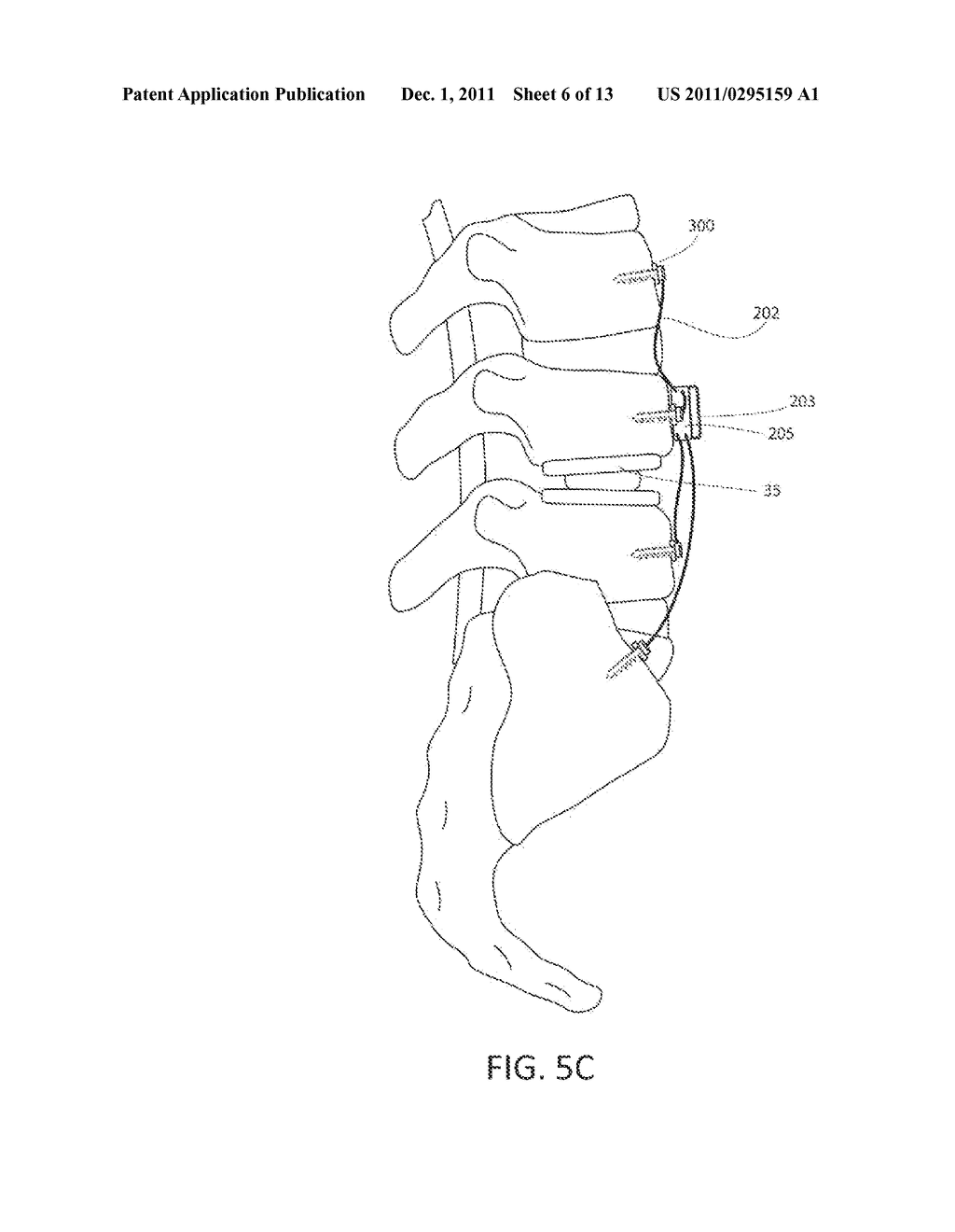 Method and Apparatus for an Implantable Inertial-Based Sensing System for     Real-Time, In Vivo Detection of Spinal Pseudarthrosis and Adjacent     Segment Motion - diagram, schematic, and image 07
