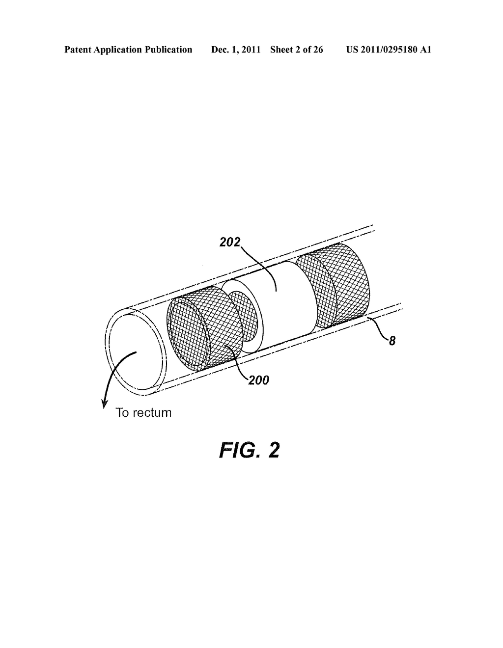 INTESTINAL BRAKE INDUCING INTRALUMINAL THERAPEUTIC SUBSTANCE ELUTING     DEVICES AND METHODS - diagram, schematic, and image 03